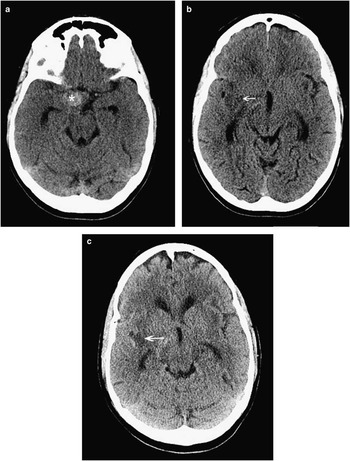 Subarachnoid Hemorrhage, Vasospasm, and Delayed Cerebral Ischemia -  Practical Neurology