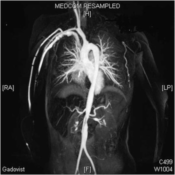 Balloon angioplasty of the bilateral renal arteries by Takayasu ...