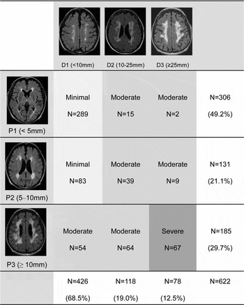 Subcortical white deals matter