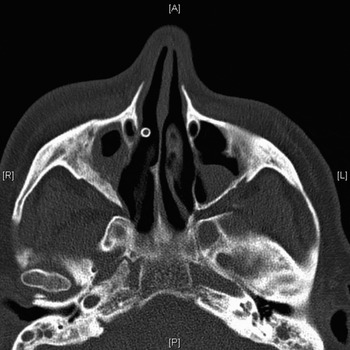 Long-term stenting for chronic frontal sinus disease: case series and ...