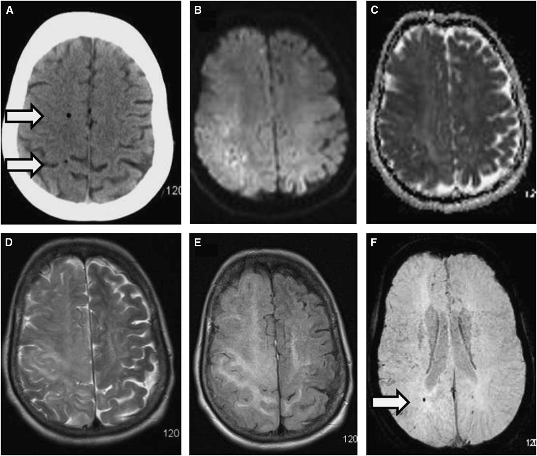 Cerebral Air Embolism During Air Flight—Neuroimaging and Management ...