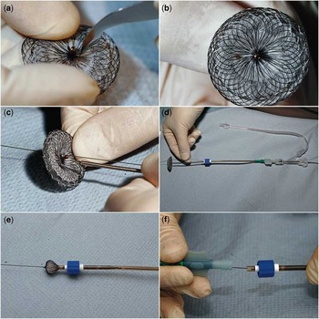 Atrial septal defect closure with an Amplatzer septal occluder ...