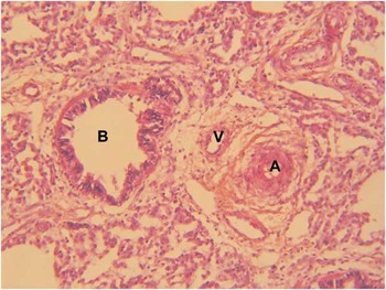 FOX gene cluster defects in alveolar capillary dysplasia associated ...