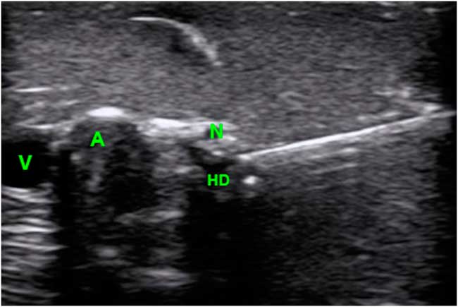 A Low-fidelity, High-functionality, Inexpensive Ultrasound-guided Nerve ...