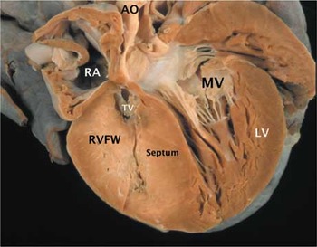 Braz J Cardiovasc Surg - The pulmonary vascular blood supply in the  pulmonary atresia with ventricular septal defect and its implications in  surgical treatment