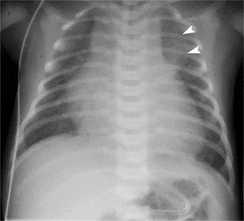 Congenital arteriovenous fistula between an intercostal artery and the ...