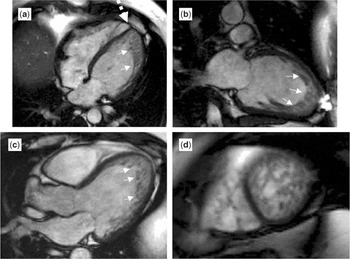 Cardiac magnetic resonance imaging in the diagnosis of biventricular  non-compaction in a young but failing heart