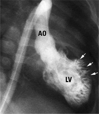 Left ventricular noncompaction: A rare indication for pediatric heart  transplantation