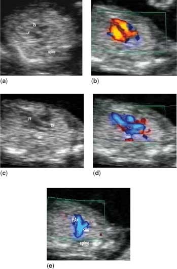 A fold nuchal is what Thick Nuchal