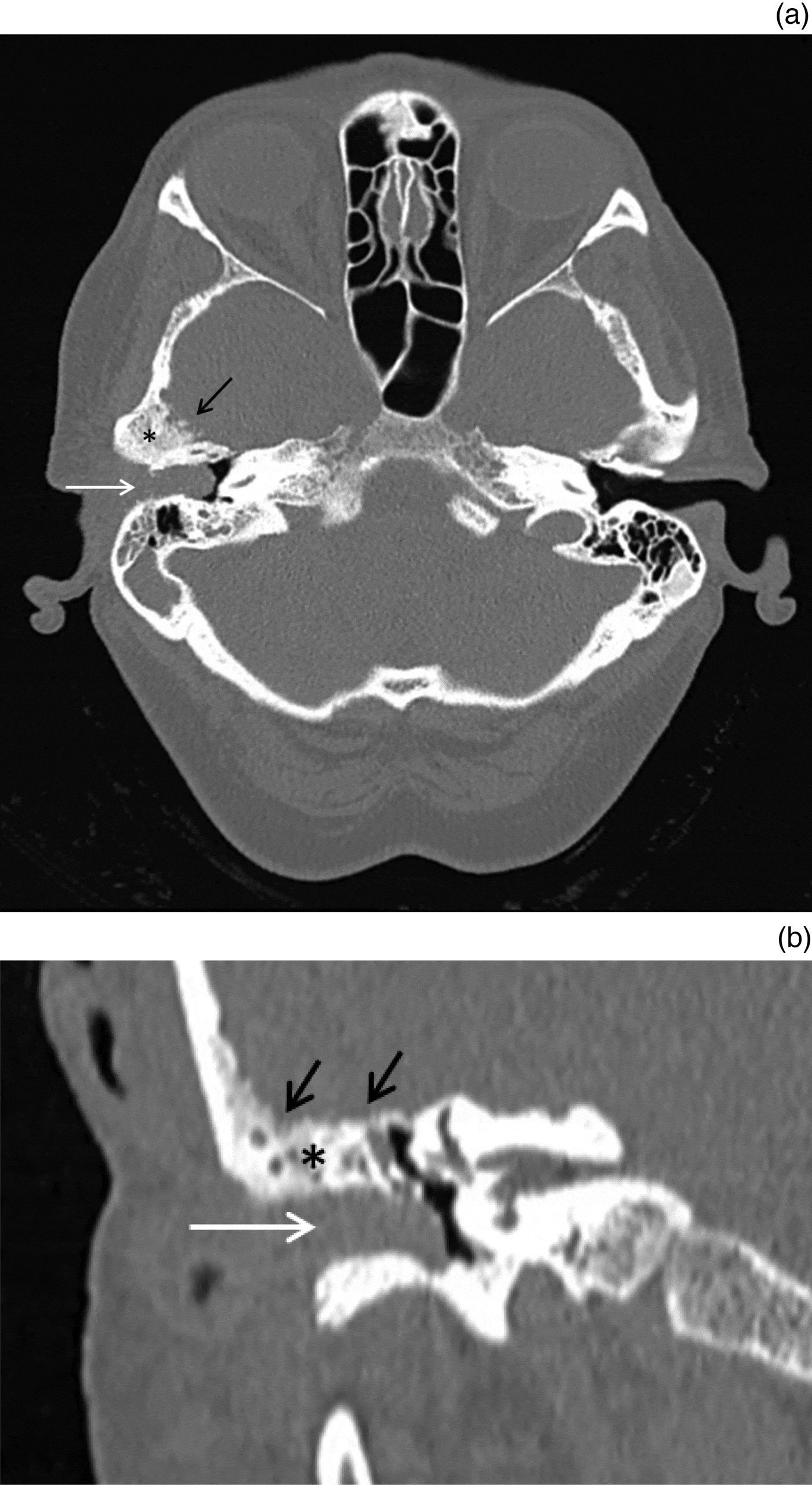 high-resolution-ct-of-external-ear-and-external-auditory-canal