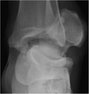 The Floating Foot: A Case Of Total Talar Dislocation 