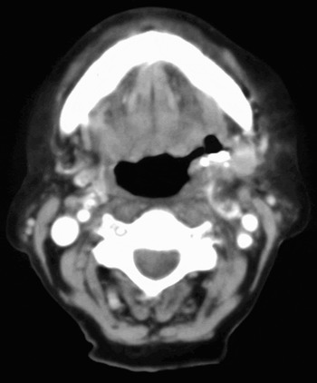 Dual pathology: cervicofacial actinomycosis and nicorandil-induced oral ...