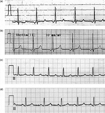 Long on QT and low on calcium | Cardiology in the Young | Cambridge Core