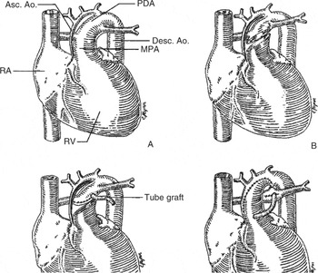 The Norwood procedure for hypoplastic left heart syndrome | Cardiology ...