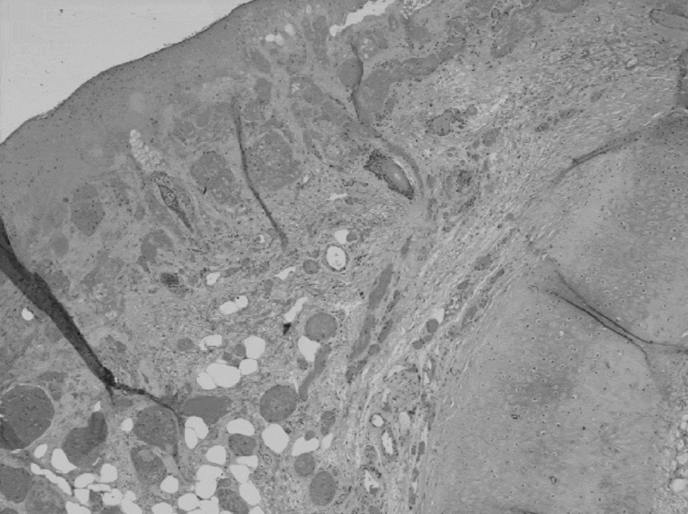 An unusual case of warfarininduced pinna skin necrosis The Journal