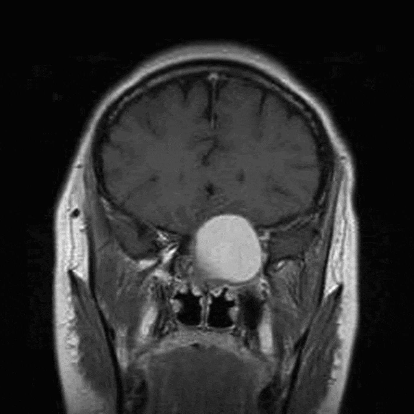 Sphenoid Sinus Mucocele 10 Cases And Literature Review The Journal Of Laryngology And Otology 1050