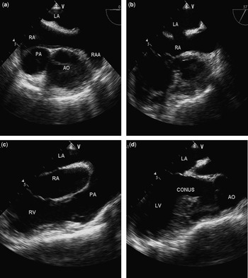 Catheter closure of an atrial septal defect in anatomically corrected ...