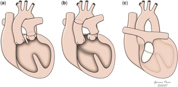 Extending the surgical boundaries in the management of the left ...