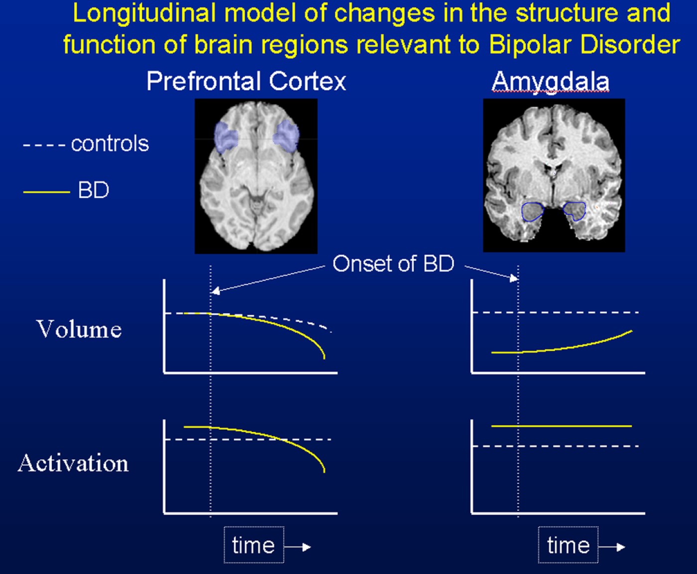 The role of the amygdala in bipolar disorder development Development