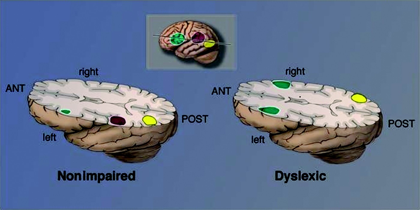 Paying attention to reading: The neurobiology of reading and dyslexia ...