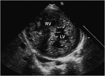 Biventricular non-compaction hypertrophic cardiomyopathy in association ...