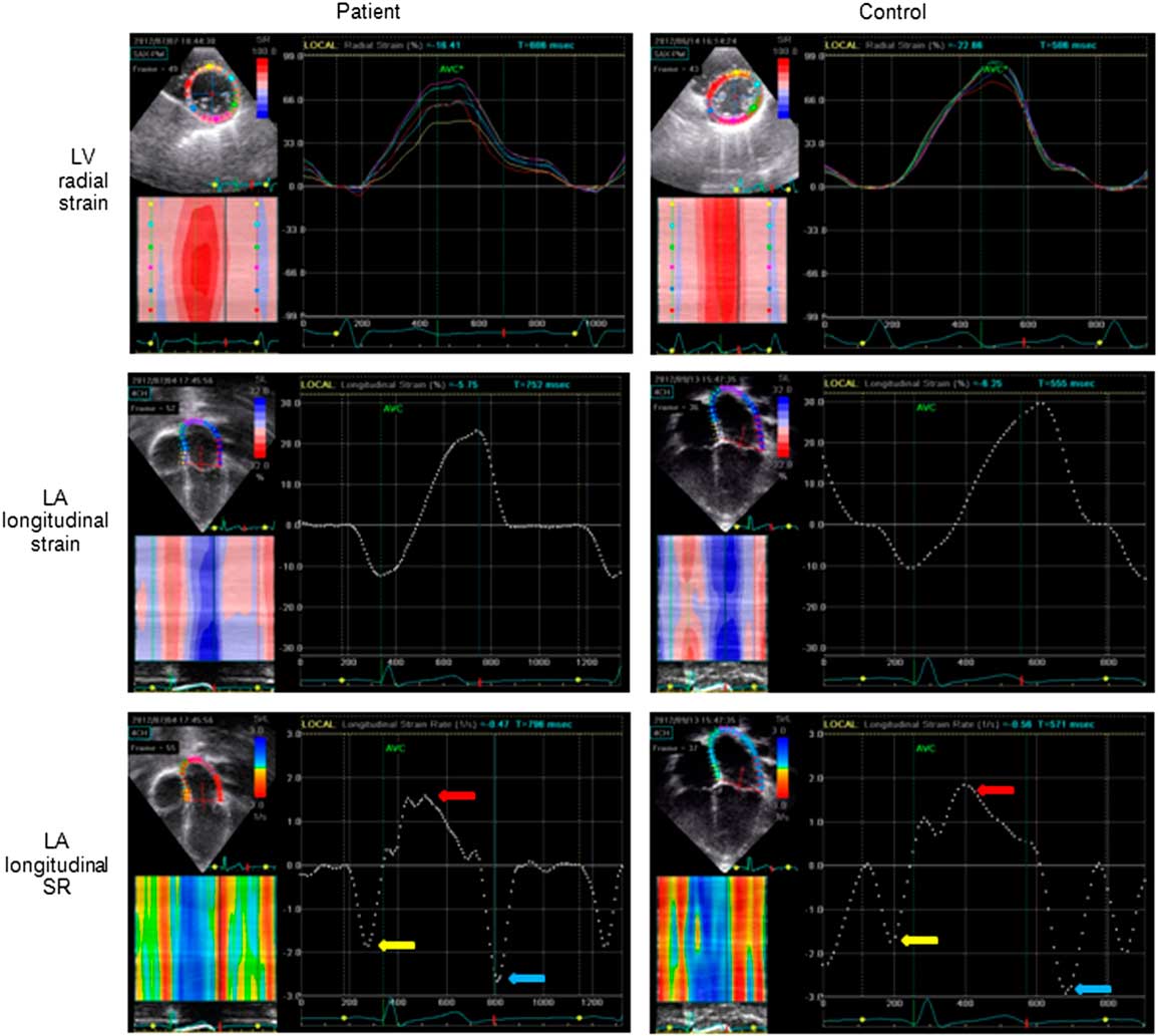 Ventricular and atrial mechanics and their interaction in patients with ...