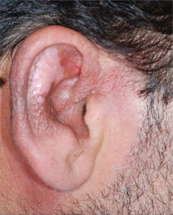 Auricular cutaneous leishmaniasis mimicking neoplastic disease | The ...