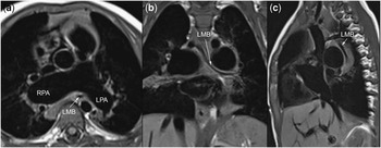 Nakata index above 1500 mm2/m2 predicts death in absent pulmonary