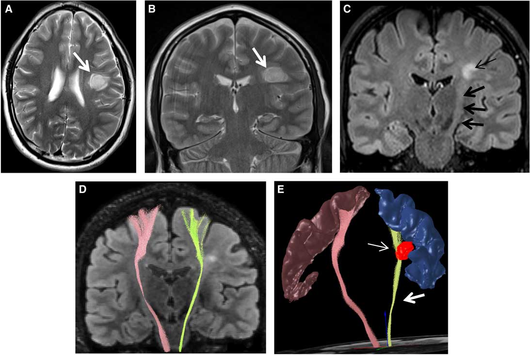 Wallerian Degeneration In The Corticospinal Tract Following Tumefactive