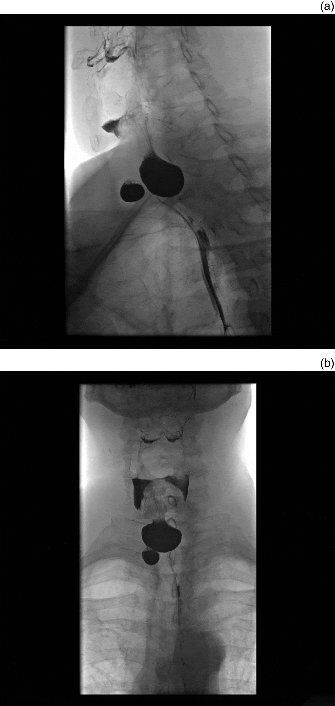 Simultaneously Occurring Zenkers Diverticulum And Killian–jamieson