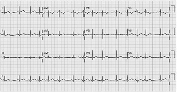 Left thoracic sympathectomy in a premature infant with long QT syndrome ...