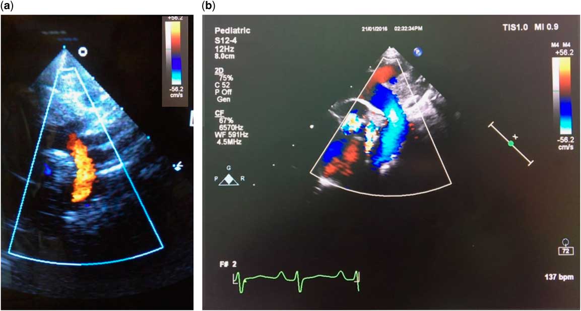 Descending aortic flow reversal in obstructed total anomalous pulmonary ...