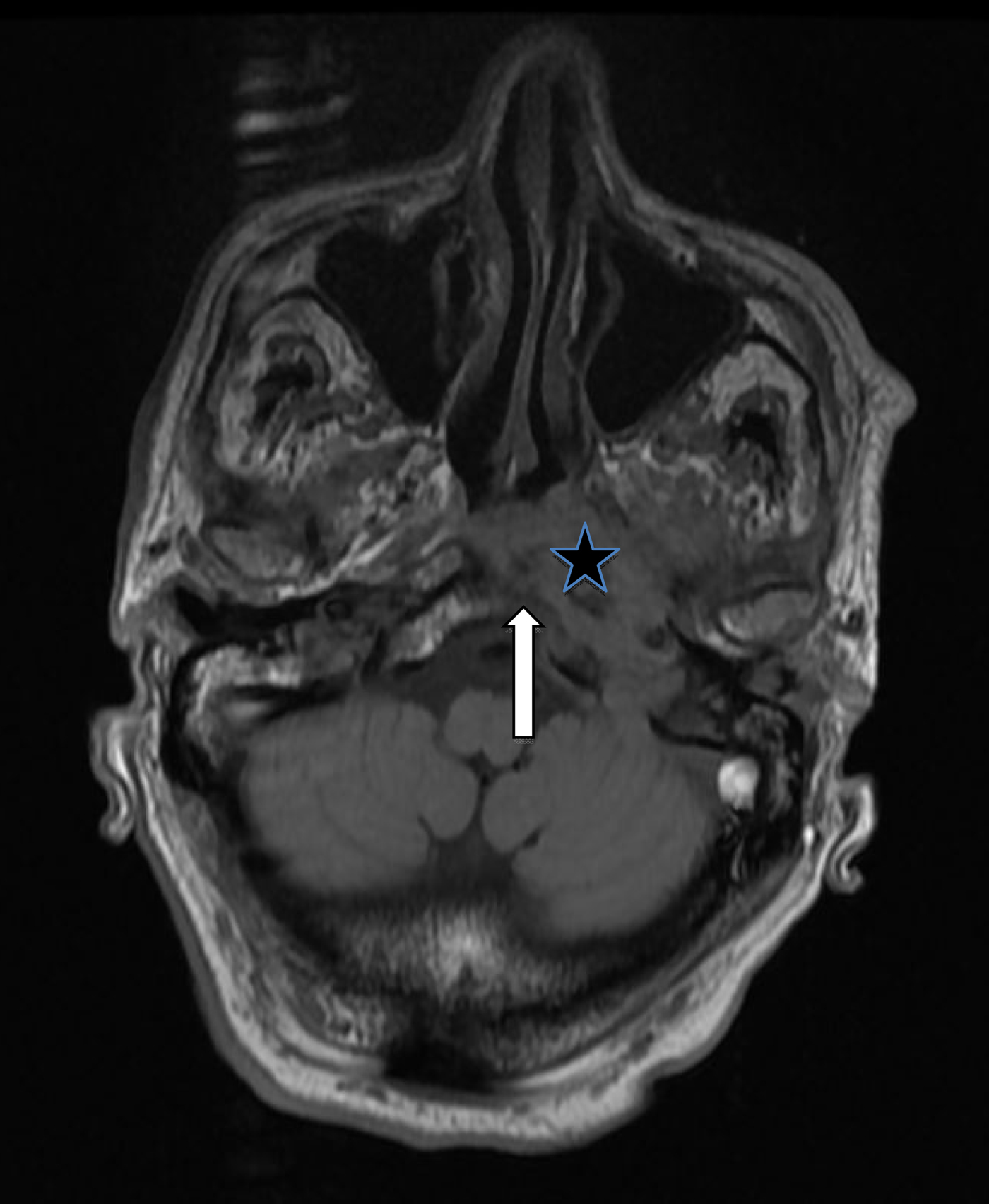 Necrotising otitis externa in the immunocompetent patient: case series ...