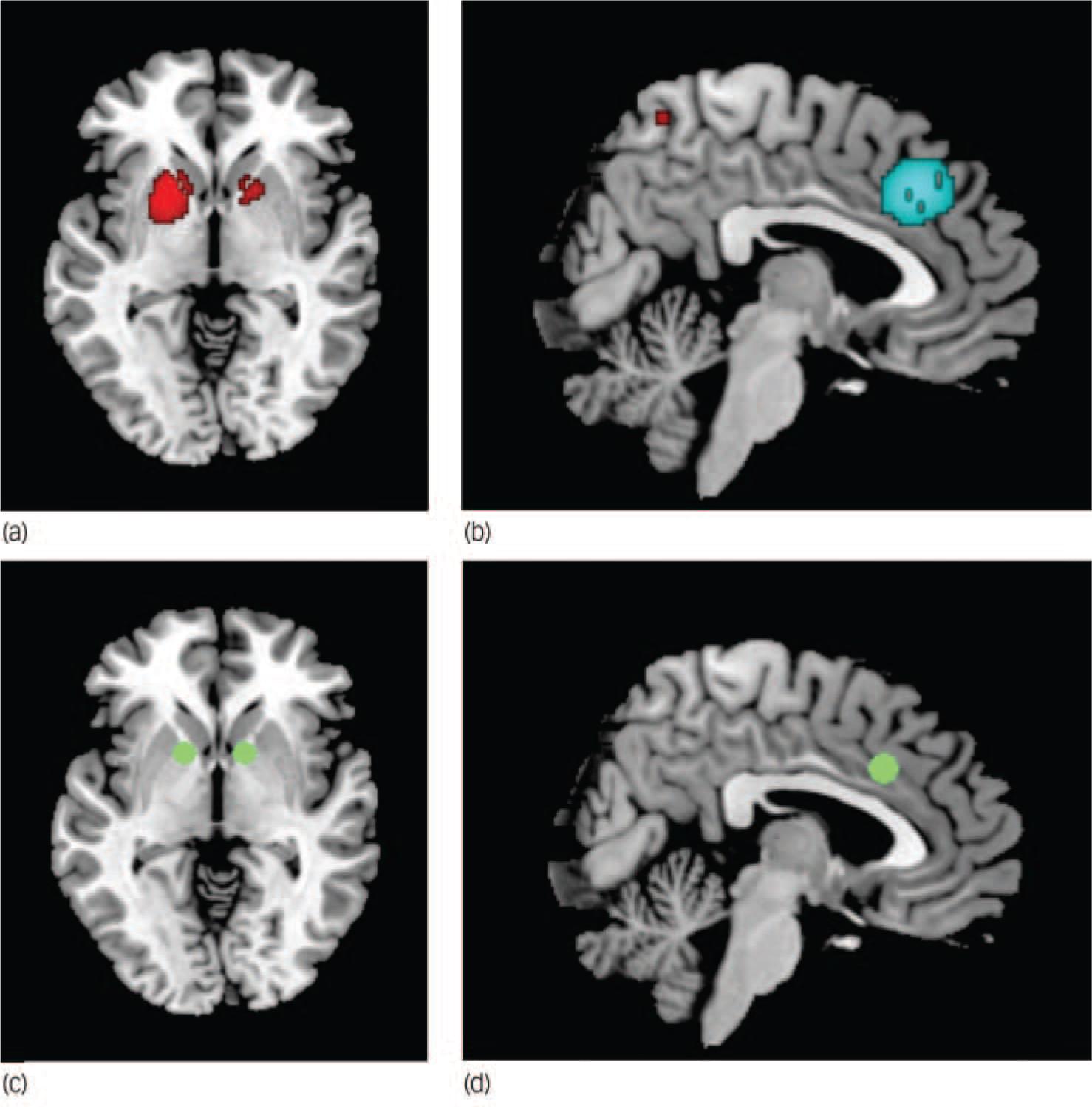 Voxel-wise meta-analysis of grey matter changes in obsessive–compulsive ...