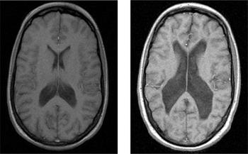 Schizophrenia Brain Scan