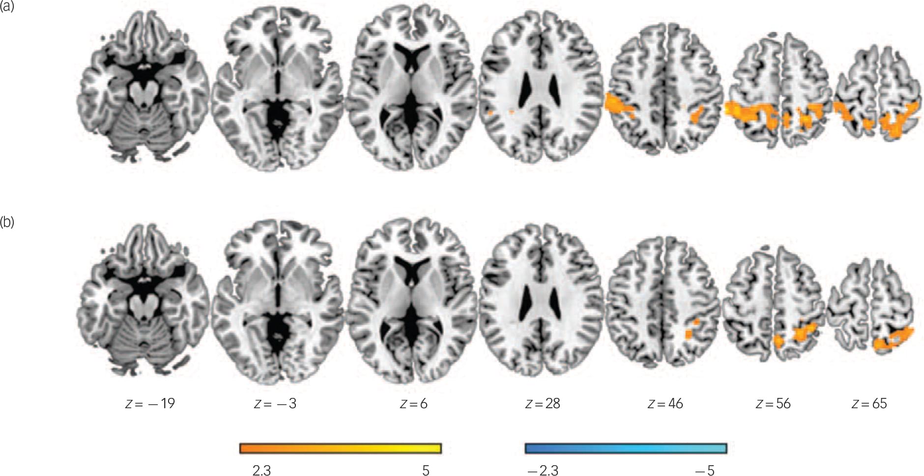 Brain functional changes across the different phases of bipolardisorder ...