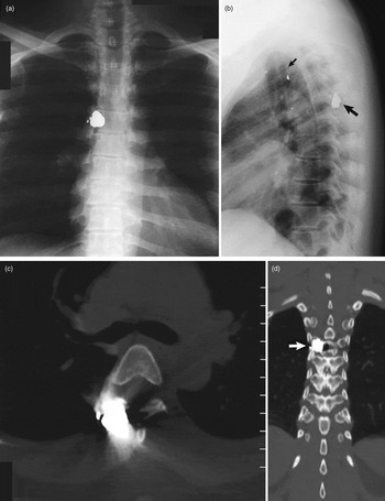 Pre-operative plain radiograph of dorso-lumbar spine Anterior-posterior