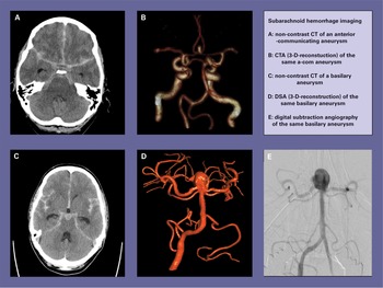 Medical interventions for subarachnoid hemorrhage (Chapter 29 