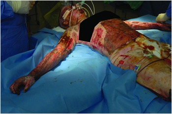 Temperature management of adult burn patients in intensive care