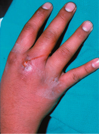 Hand Infections Fight Bite Purulent Tenosynovitis Felon and