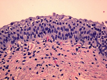 Differential expression of immunohistochemical markers in bladder smooth  muscle and myofibroblasts, and the potential utility of desmin, smoothelin,  and vimentin in staging of bladder carcinoma - Modern Pathology