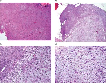 Frontiers  Nodular and diffuse spindle cell infiltration in keloidal  scleroderma: a case report