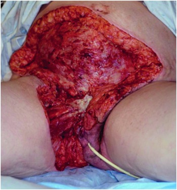 Vaginal mass with necrotic appearance obstructing the vaginal