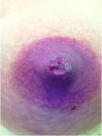 Nipple Pain Causes  Brooklyn Gynecology Services