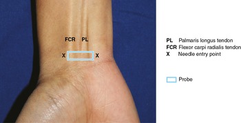 Median nerve at the wrist - Sonoanatomy for Anaesthetists