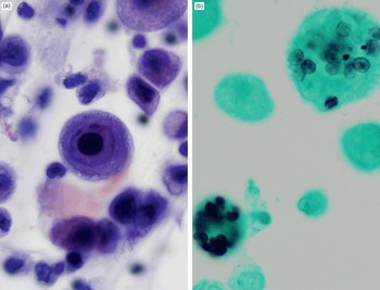 reed sternberg cells vs cmv