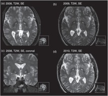 Pantothenate Kinase Deficiency Chapter 81 Progressive Brain Disorders In Childhood