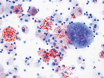 Exfoliative Pulmonary Cytology Chapter 1 Diagnostic Pediatric Cytopathology And Histopathologic Correlation