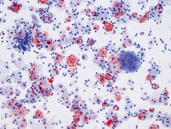 Exfoliative Pulmonary Cytology Chapter 1 Diagnostic Pediatric Cytopathology And Histopathologic Correlation