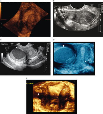 Uterine prolapse. (left) Lateral view of pelvis showing normal pelvic ß